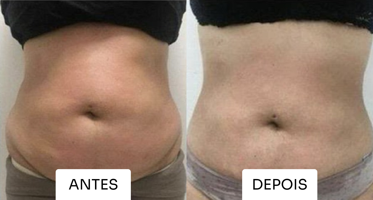 Resultado Mitras Estética 1