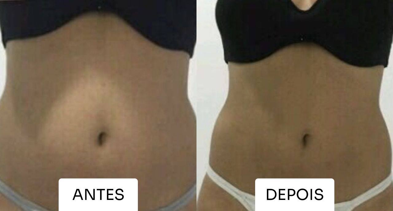 Resultado Mitras Estética 7