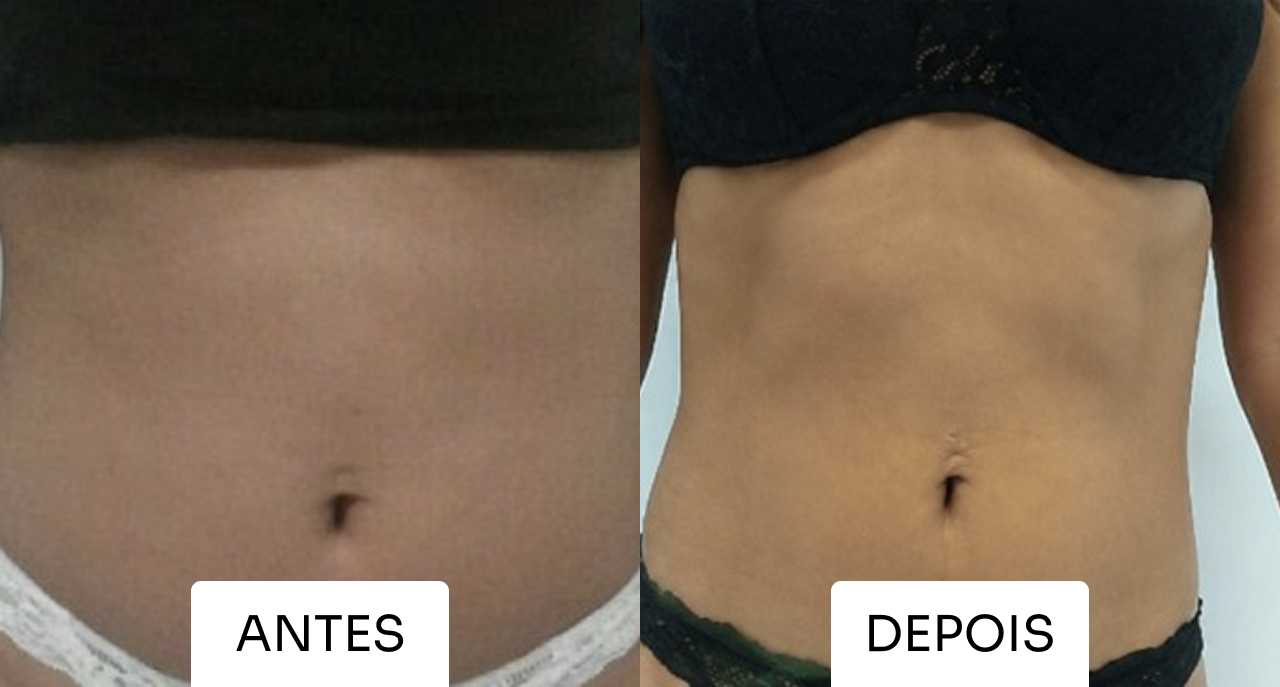 Resultado Mitras Estética 6