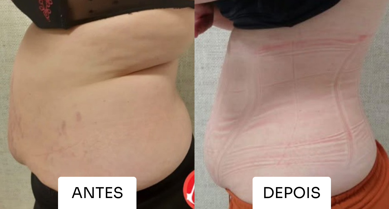 Resultado Mitras Estética 4