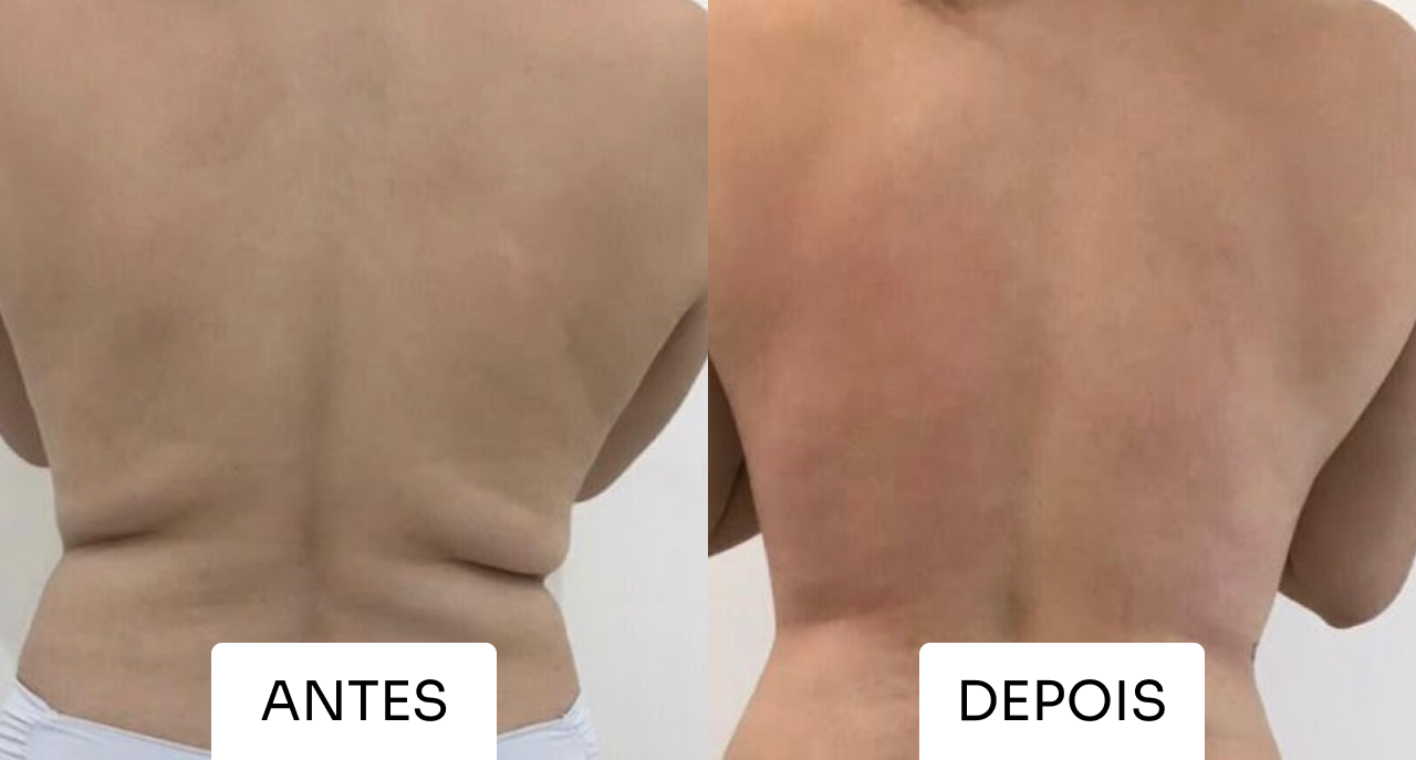 Resultado Mitras Estética 3