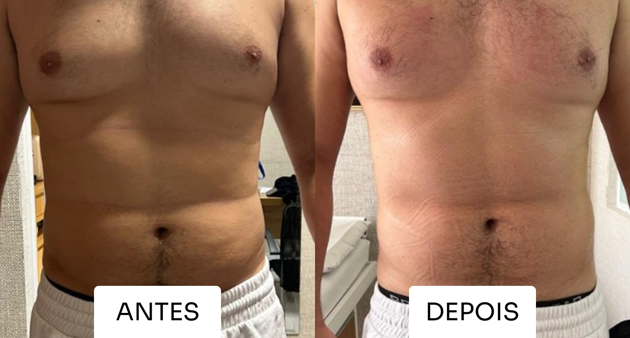 Resultado Mitras Estética 5