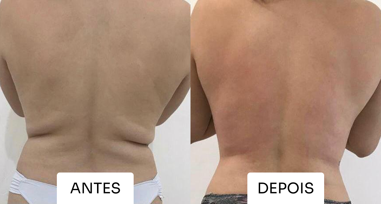 Antes e depois Mitras Estética 6