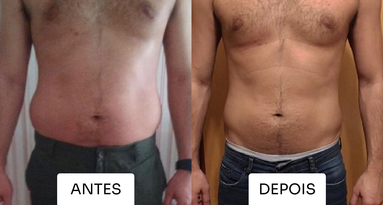 Antes e depois Mitras Estética 5