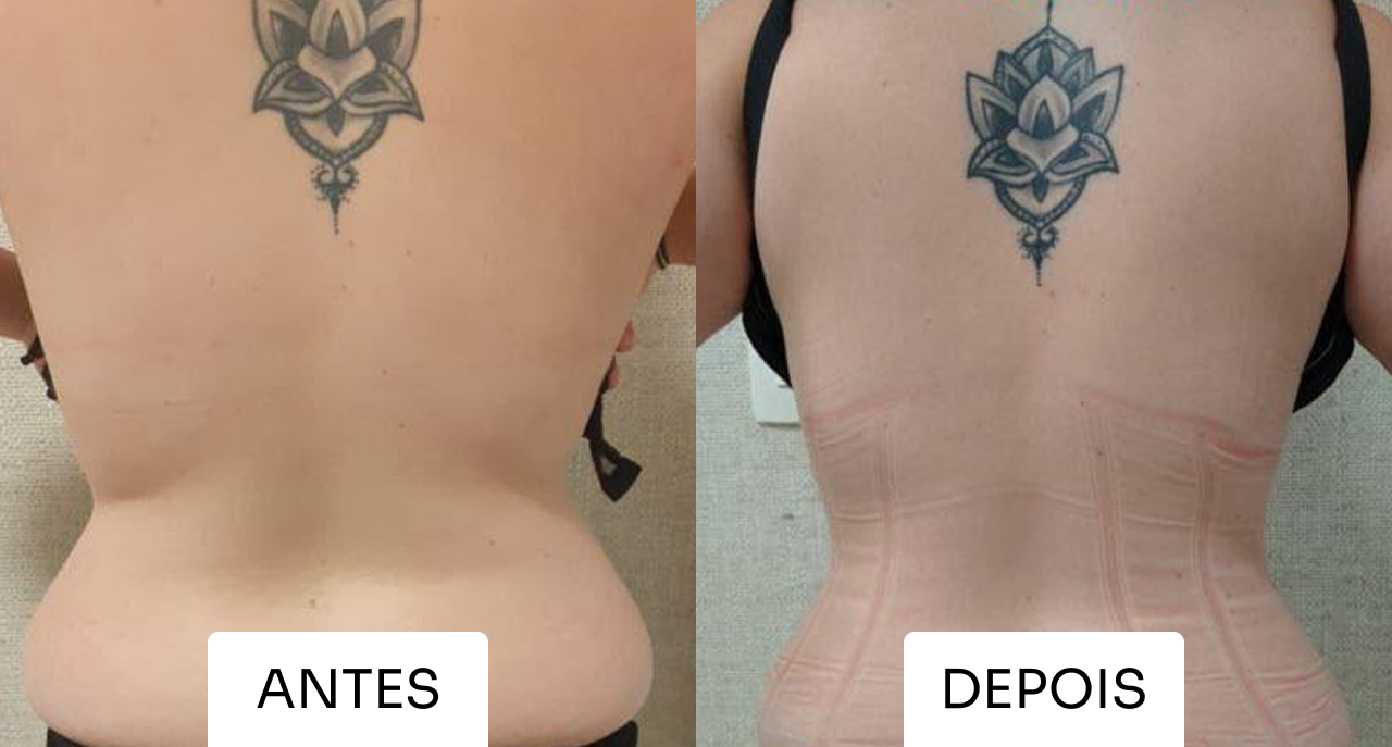 Antes e depois Mitras Estética 4