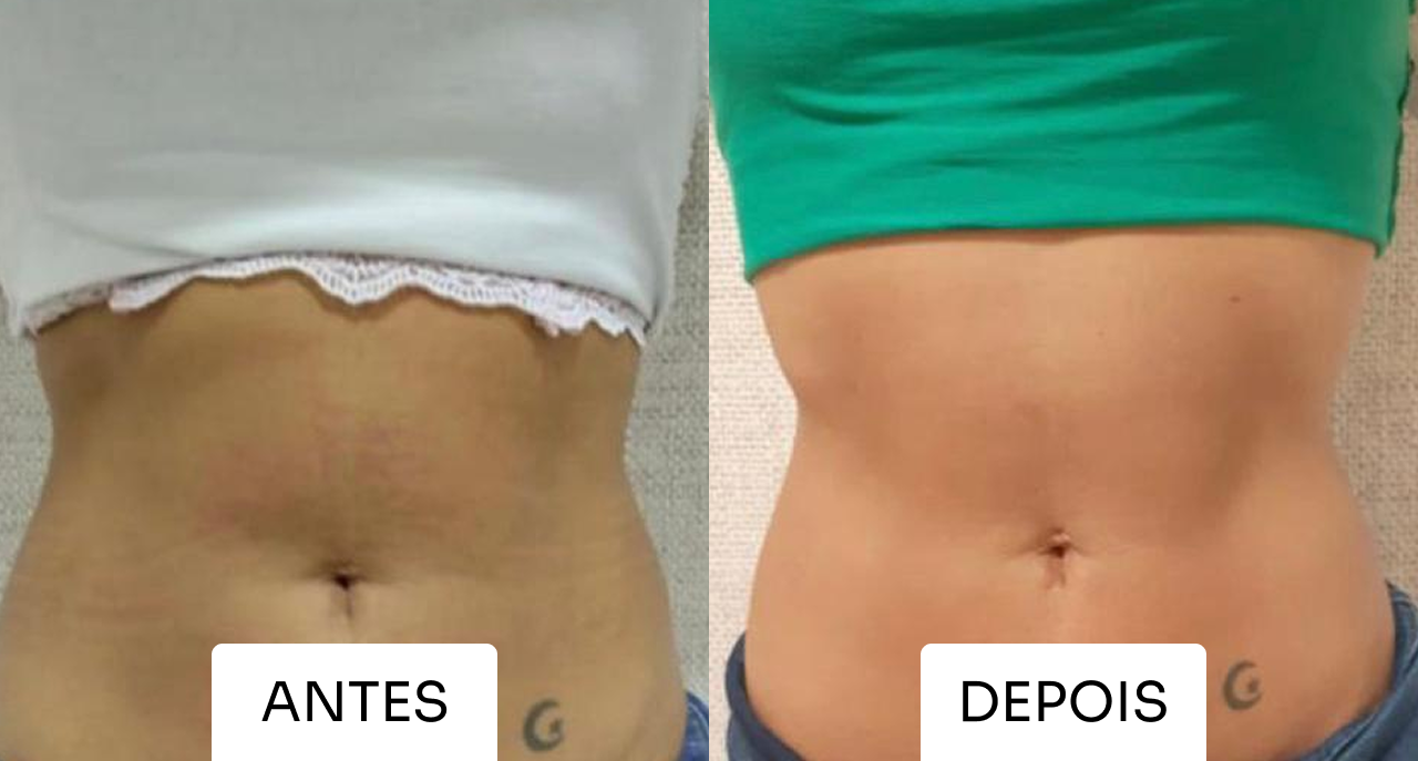 Antes e depois Mitras Estética 3