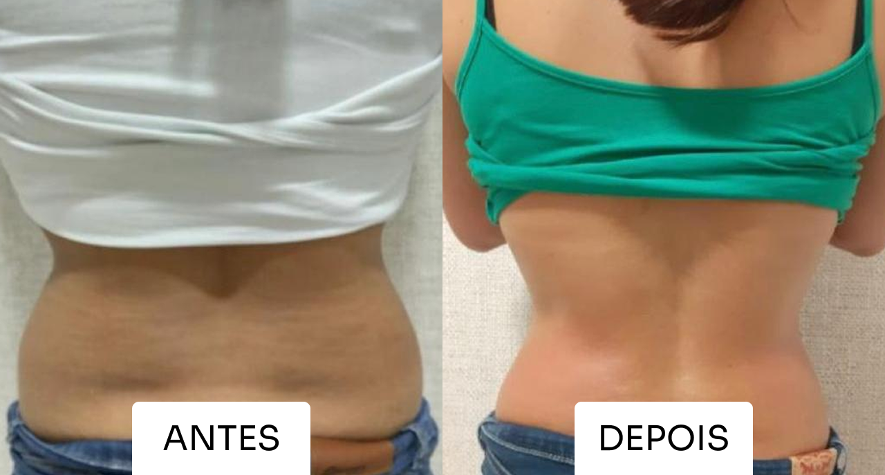 Antes e depois Mitras Estética 2