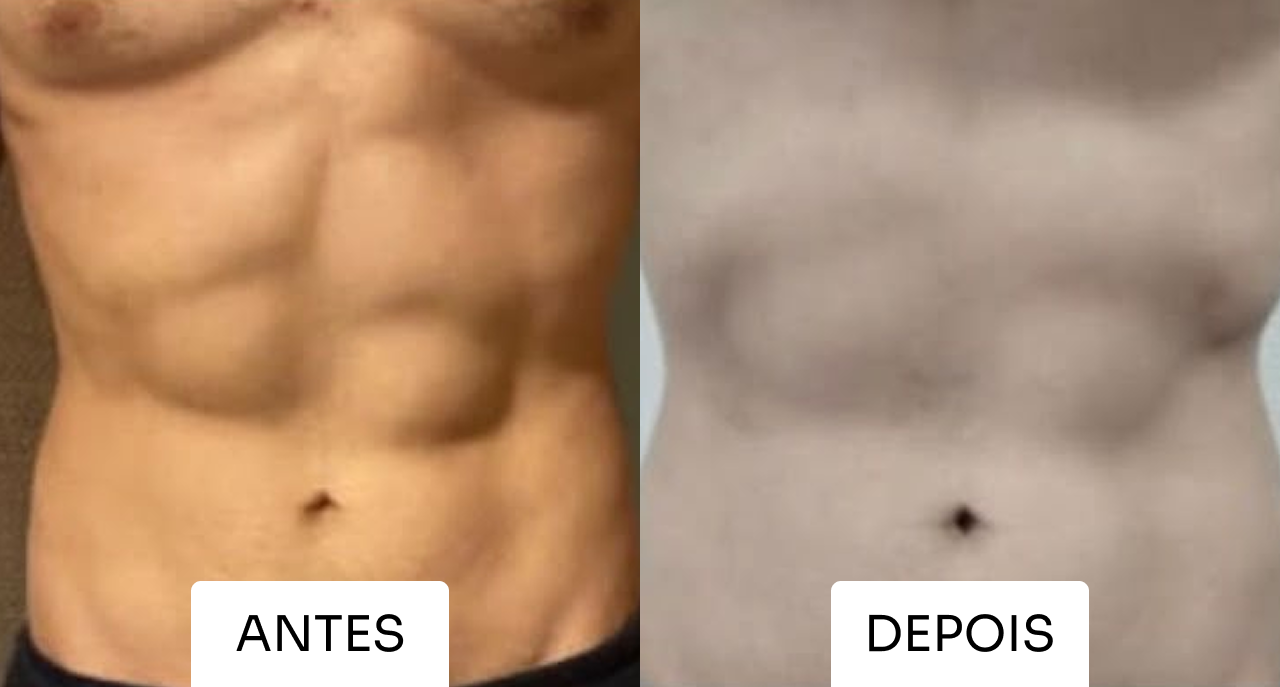 Antes e depois Mitras Estética 1